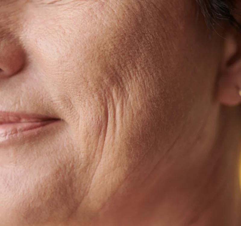 Fine Lines & Wrinkles